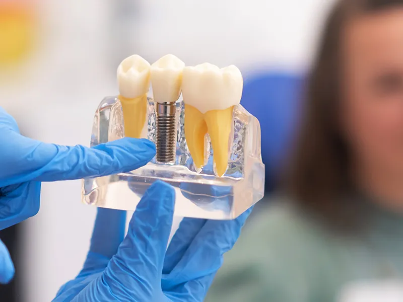 Implantes Dental Y Corona