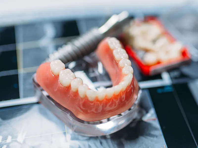 Prótesis dental